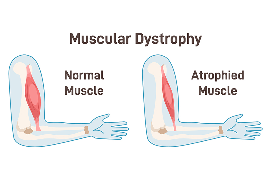 An arm muscle of a person with muscular dystrophy is smaller than a normal person’s arm muscle.