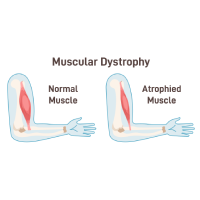 Image depicting anatomical structure of healthy human muscle in arm and muscle with Duchenne muscular dystrophy