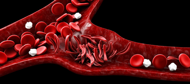 Image shows sickle cells blocking circulation of red blood cells.