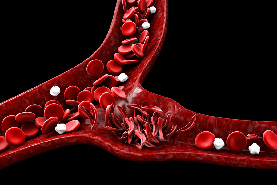Image shows sickle cells blocking circulation of red blood cells.
