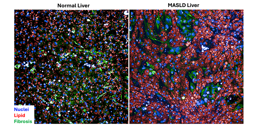 Figure B-2. Tissue chip models used to study the progression of metabolic dysfunction–associated steatotic liver disease (MASLD), which affects a quarter of the world’s population. On the left, a normal liver is shown with four different types of cells. On the right, a diseased liver reveals a high amount of fatty lipids and the beginning of fibrosis, a life-threatening type of liver damage. (Dillon Gavlock, University of Pittsburgh Drug Discovery Institute)