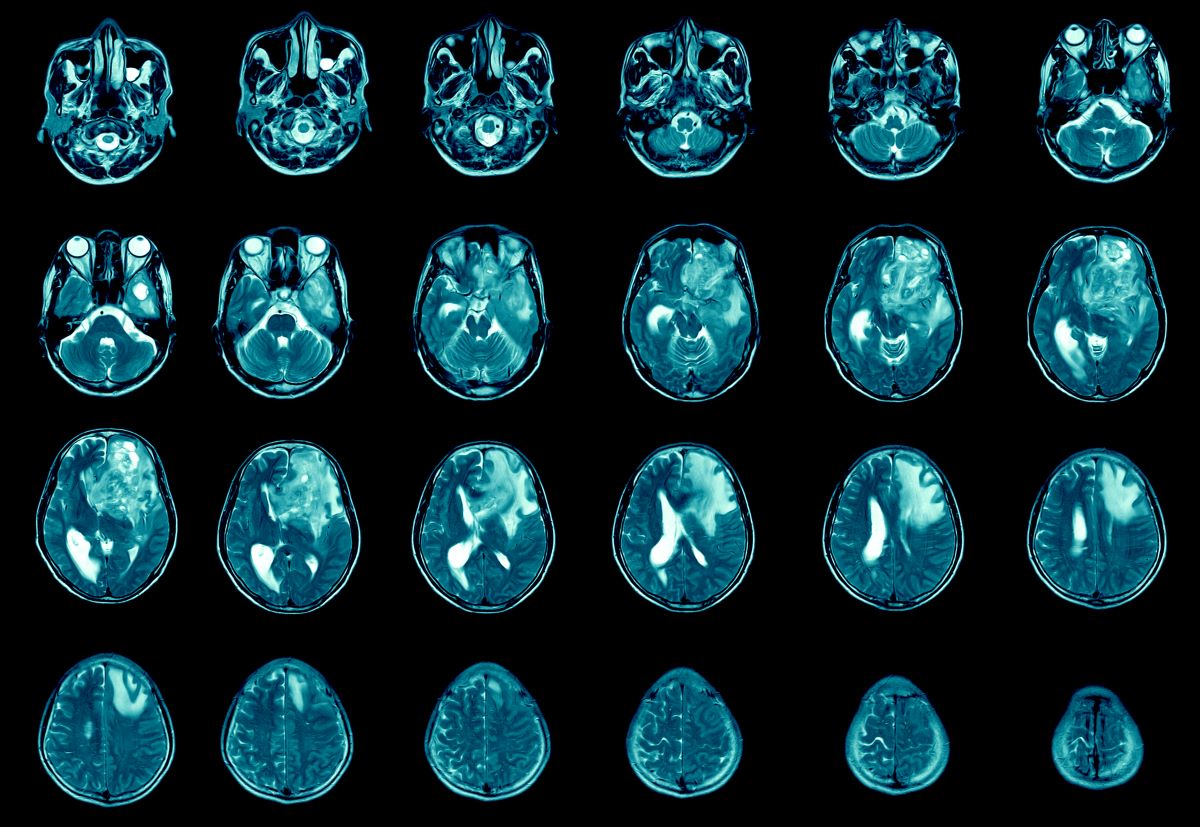 Magnetic resonance images of glioblastoma.