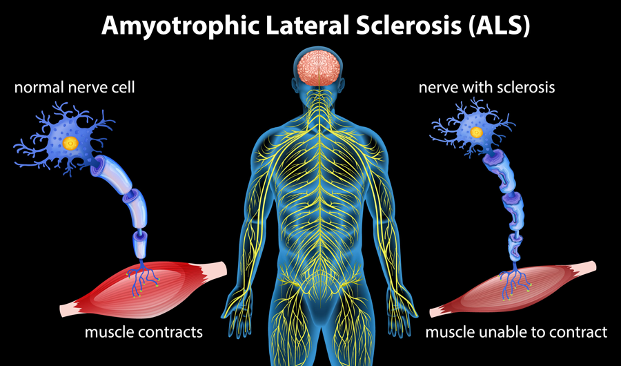 Illustration of the human nervous system with examples of a normal nerve cell contracting muscles and a nerve cell affected by amyotrophic lateral sclerosis that cannot contract muscles.
