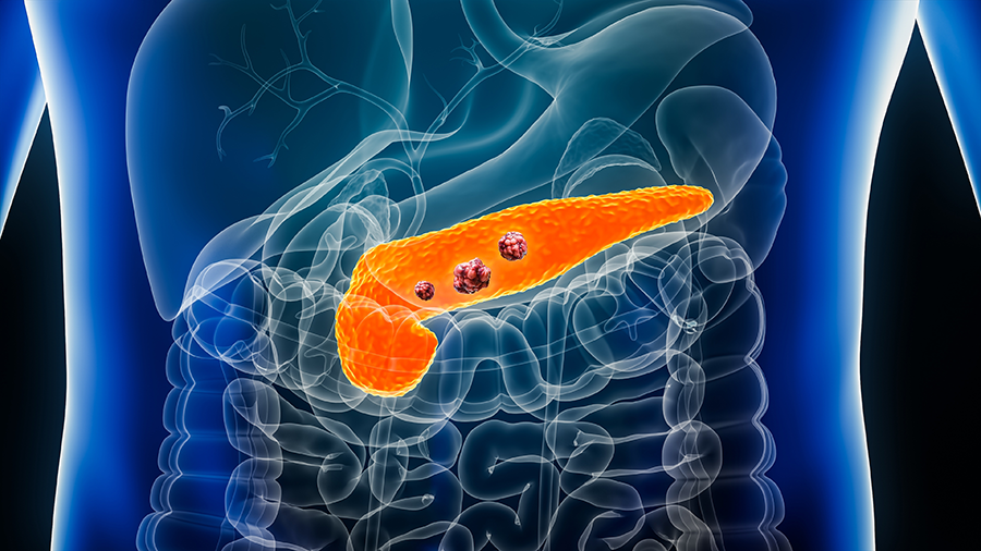 3D illustration of pancreas with tumors in the human body.