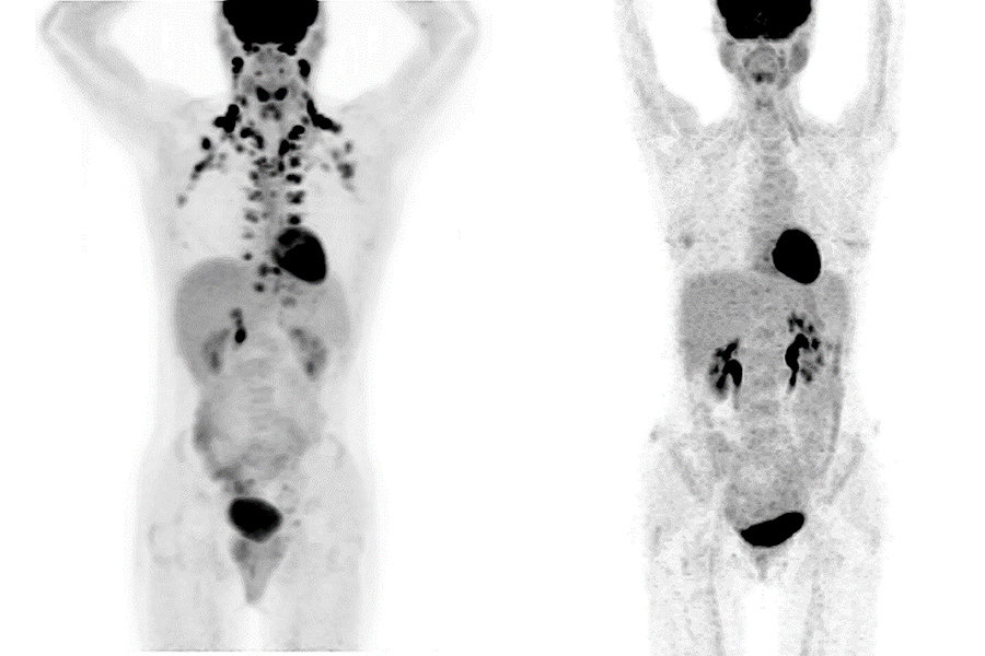 Two PET-scan photos showing locations of brown fat deposits in the human body.
