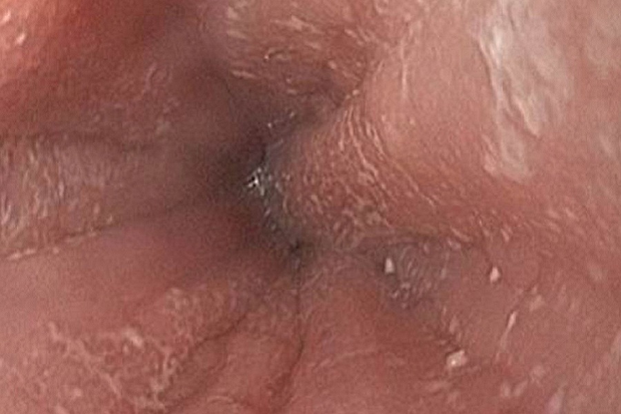 Eosinophilic esophagitis