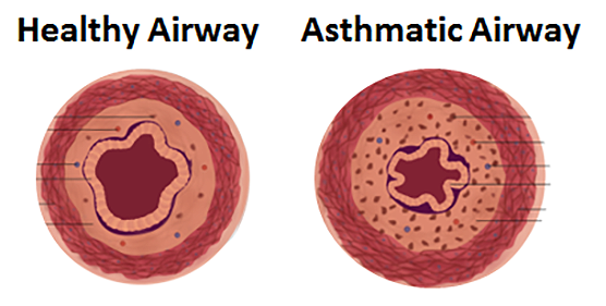 The image on the left shows a cross-section of an airway in a healthy lung; the image on the right shows an asthmatic airway, which has a narrowed opening because the muscles are squeezing too tightly.