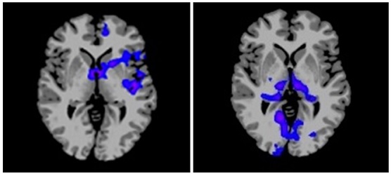 Brain responses to glucose and fructose ingestion show a distinctly different pattern. Glucose reduced blood flow and activity in brain regions that control appetite and reward (shown in blue at left). In contrast, appetite and reward regions remained active after fructose ingestion but activity in memory and sensory perception (shown in blue at right) was suppressed. These images represent composite data from 20 healthy adult volunteers. (Yale University Photo)