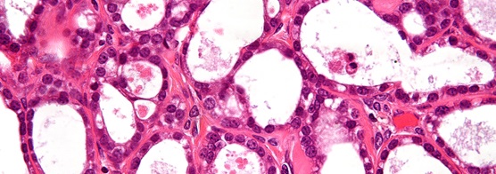 Very high magnification micrograph of an ovarian clear cell carcinoma. (Credit: http://bit.ly/1GXE2mc. Copyright: http://bit.ly/1fd019p)