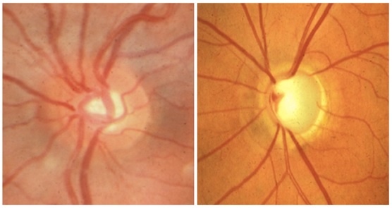 The image on the left shows the optic disc from a normal eye. The image on the right shows the disc from an eye in which the optic nerve has been damaged by glaucoma.