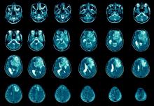 Magnetic resonance images of glioblastoma