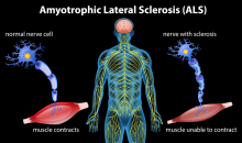 Illustration of the human nervous system with examples of a normal nerve cell contracting muscles and a nerve cell affected by amyotrophic lateral sclerosis that cannot contract muscles.